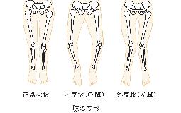 膝の痛む原因？